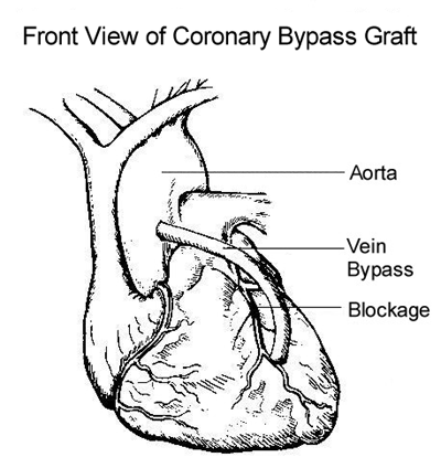 Coronary Artery Bypass Graft (Vein) Coronary Artery Bypass Graft (Vein)