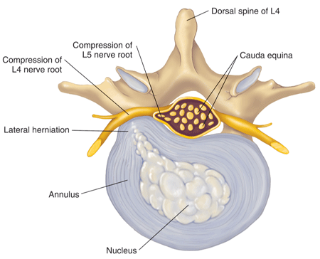 Herniated disc drawing Herniated disc drawing