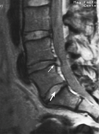 MRI of herniated disc MRI of herniated disc