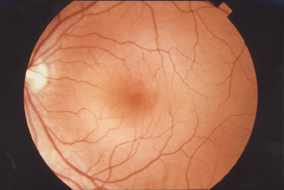 Normal Fundus Normal Fundus
