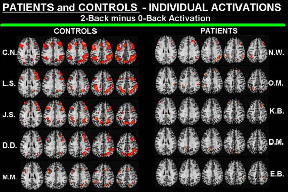 Schizophrenia PET Scans Schizophrenia PET Scans