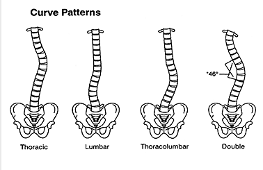 Scoliosis Scoliosis