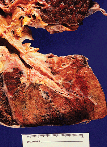 Smoker's lung Smoker's lung