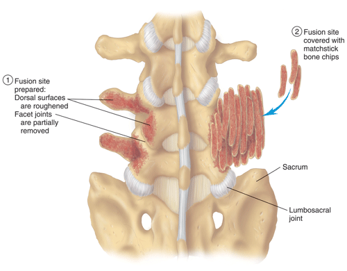 Vertebral fusion Vertebral fusion